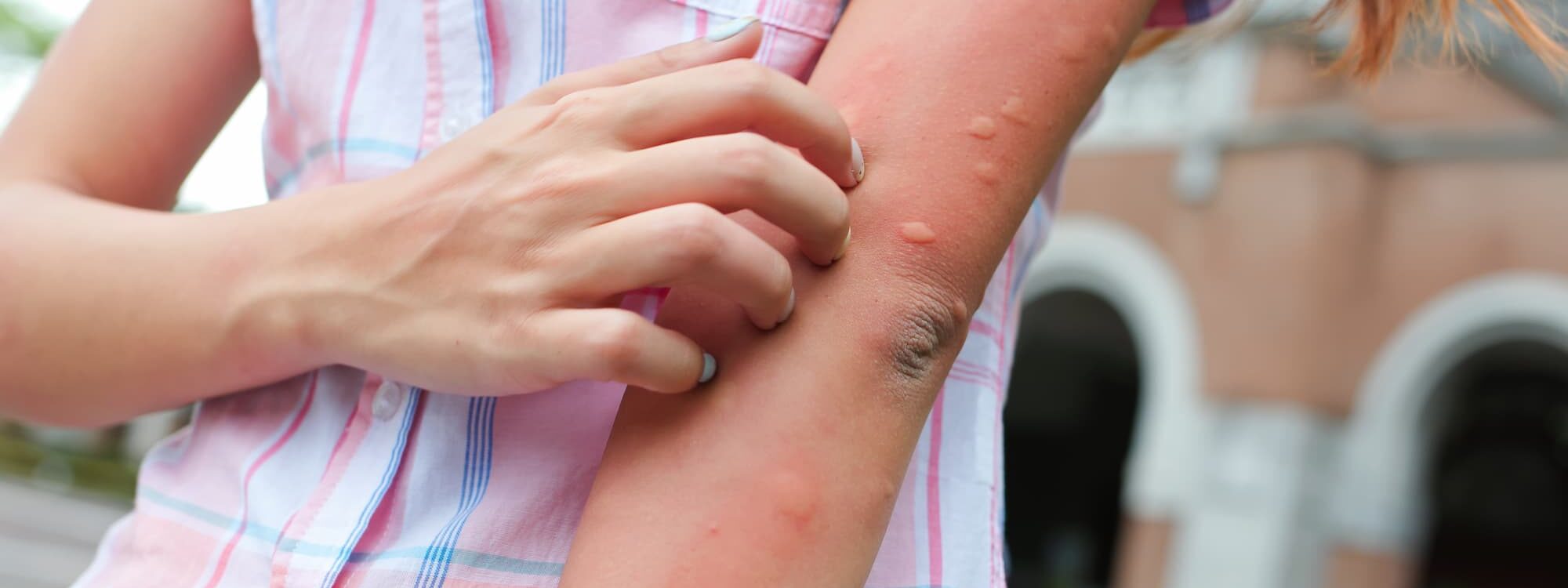 PIQURE 2000X750 | PREVALSACE Piqûres d’insectes, allergies, insolations : comment bien réagir en été au travail ? Erstein