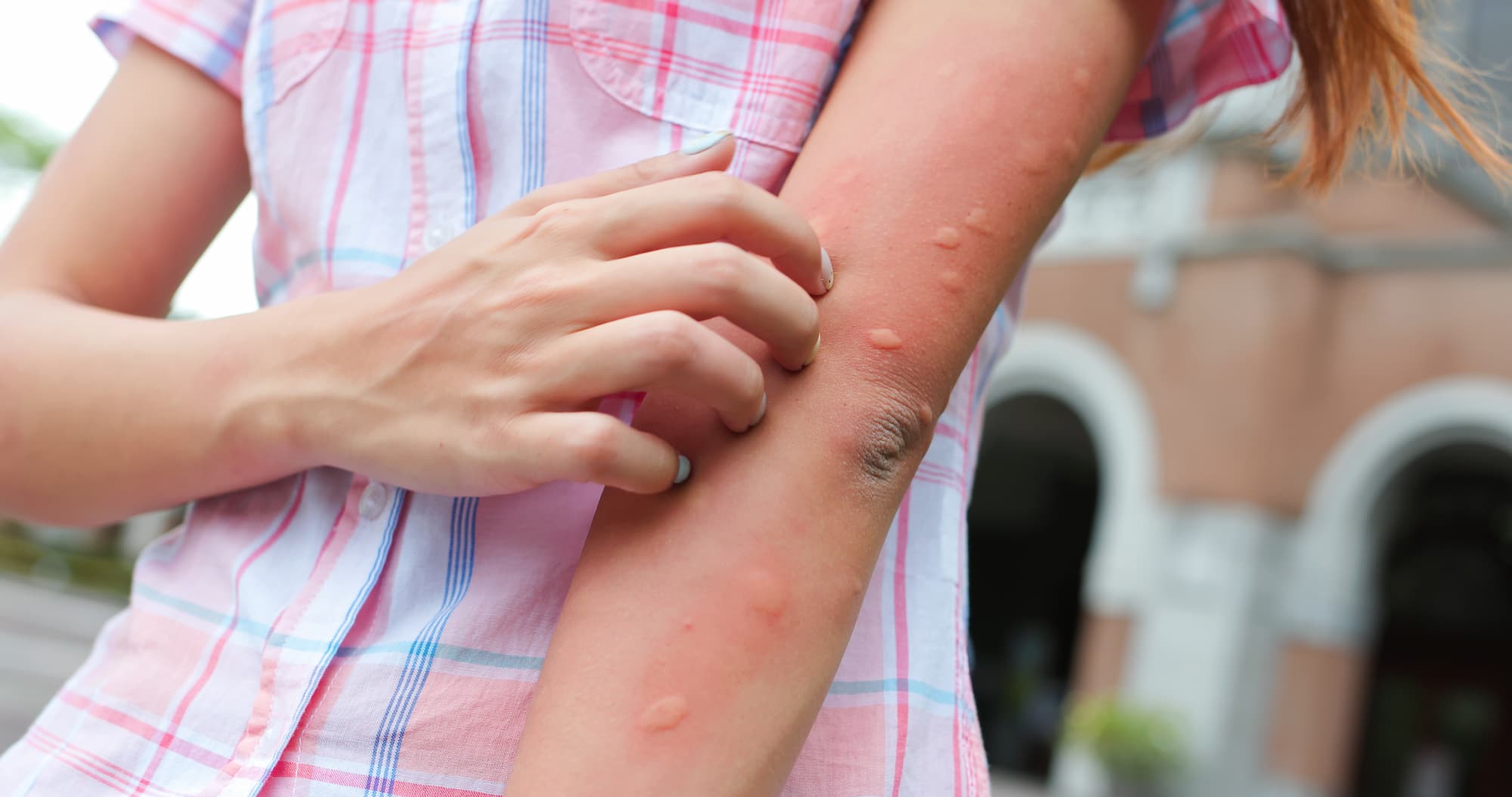 Piq&ucirc;res d&rsquo;insectes, allergies, insolations : comment bien r&eacute;agir en &eacute;t&eacute; au travail ? Erstein